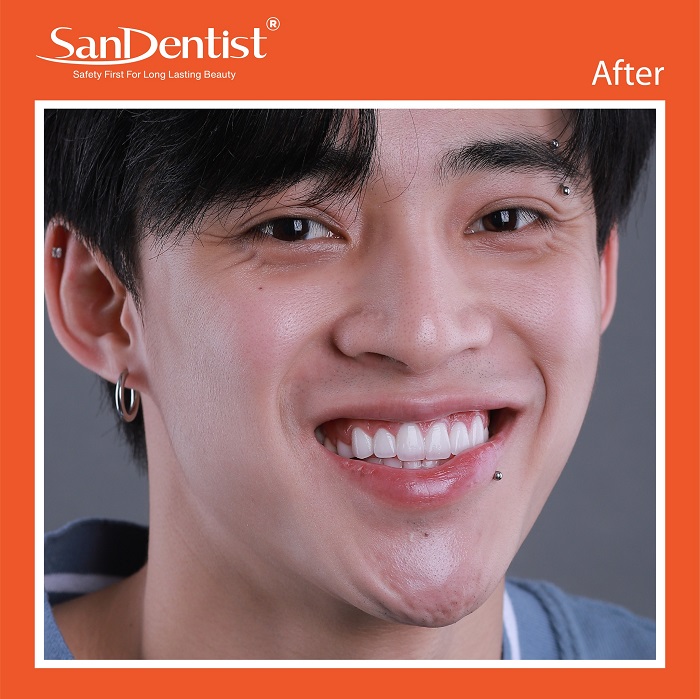 Trồng răng Implant tại TPHCM - San Dentist